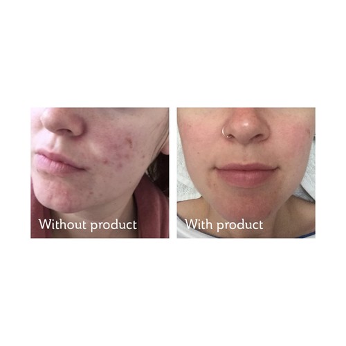 Science of Skin Rescue Facial Scarring