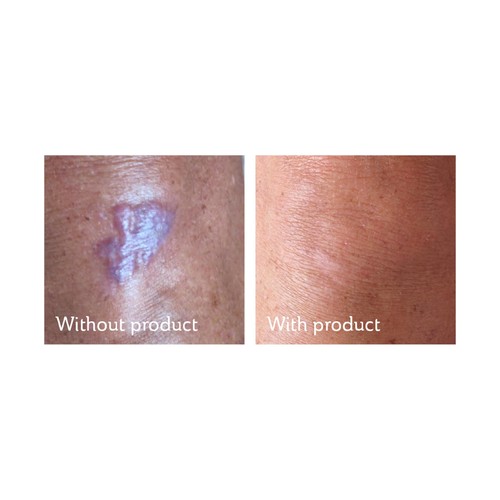 Science of Skin Solution for Scars
