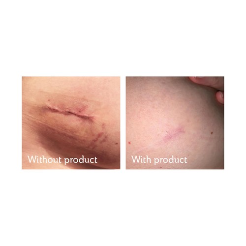 Science of Skin Solution for Scars