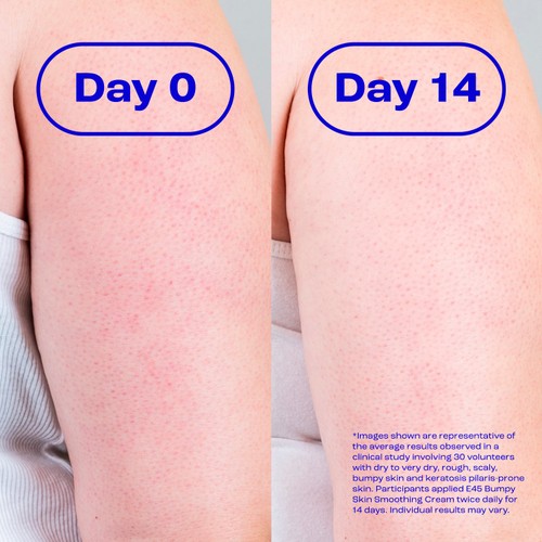 E45 Bumpy Skin Smoothing Cream 