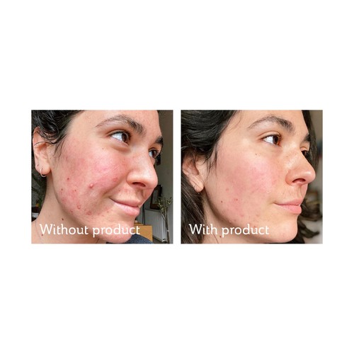 Science of Skin Rescue Facial Scarring