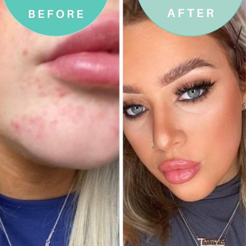 Skin Genius Hits The Spot Spot Zapper