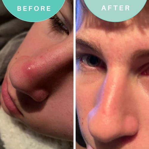 Skin Genius Hits The Spot Spot Zapper