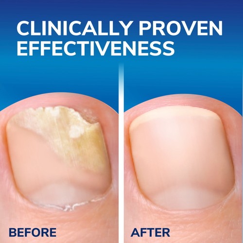 Dr. Scholl's Fungal Nail 2 in 1 Treat & Shield