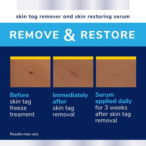 Scholl Skin Tag Complete Care