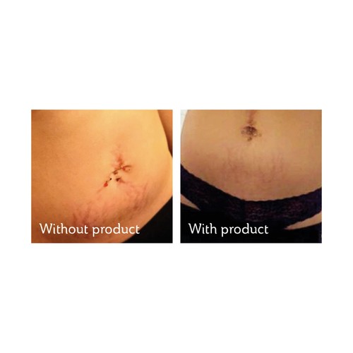 Science of Skin Solution for Stretch Marks