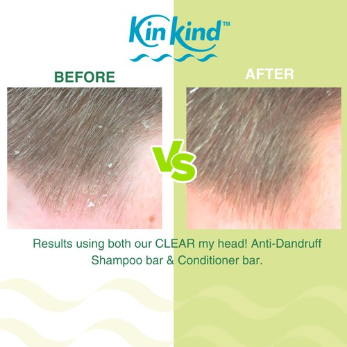 KinKind CLEAR My Head! Anti Dandruff Solid Shampoo Bar for Flaky Scalp