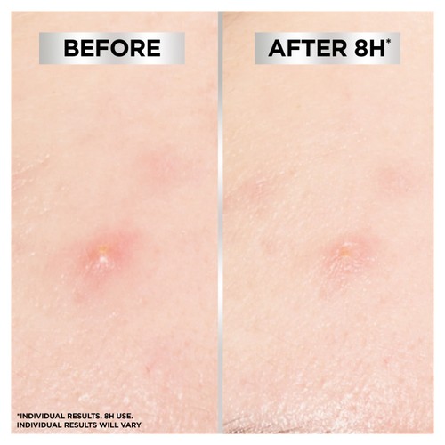 Garnier Invisible Pimple Patch